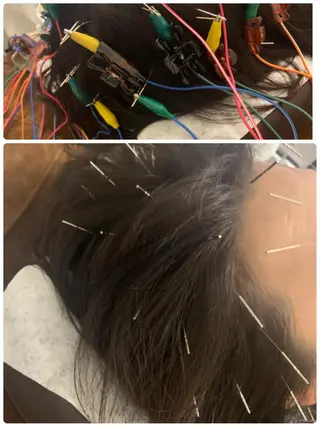 表参道鍼灸院K 美容鍼🔮ララピールのエステ・リラクイメージ