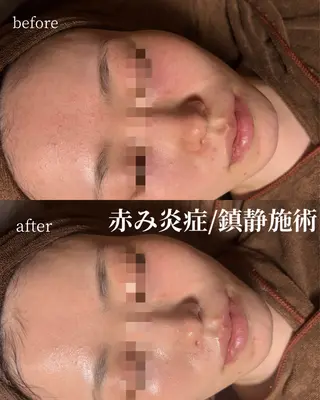 HINANO矢場町店【ヒナノ】所属・脱毛/肌改善🌿 HINANO 村田のエステ・リラクイメージ