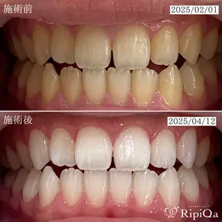 セルフホワイトニング RipiQaのその他イメージ