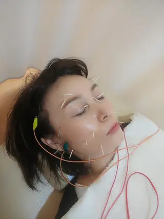 リフトアップ・たるみ ☆美容鍼小顔矯正のその他イメージ