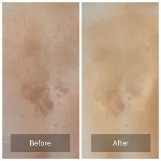 ハーブピーリング Lanaのエステ・リラクイメージ