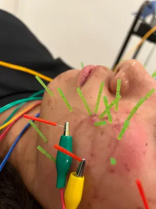 美容鍼灸Solana所属・肌質改善×美容鍼 ゆいのエステ・リラクイメージ