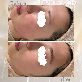 ミディアム カラー パーマ ヘアアレンジ メンズ キッズ ネイル マツエク・マツパ アイブロウ ニキビ&跡改善サロン オーナー光木のエステ・リラクイメージ