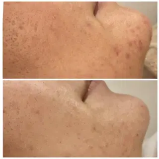 セミロング カラー パーマ ヘアアレンジ メンズ キッズ ネイル マツエク・マツパ アイブロウ 🔥3か月で肌革命 🔥ニキビ専門店のエステ・リラクイメージ