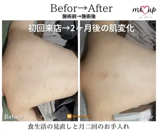 Meupニキビ専門店 背中/ハーブ/肌管理のその他イメージ