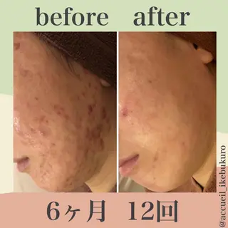 ミディアム カラー パーマ ヘアアレンジ メンズ キッズ ネイル マツエク・マツパ ニキビ・肌質改善専門 ♡人生が変わるサロンのエステ・リラクイメージ