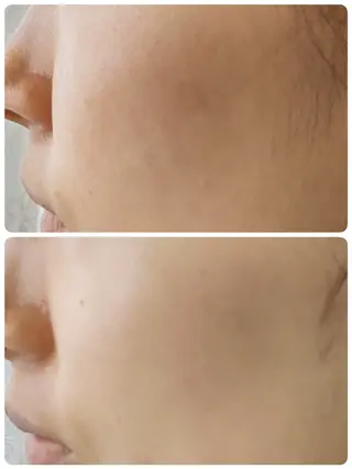 角質・毛穴洗浄🌼 脱毛🌸嶋津弘美のエステ・リラクイメージ