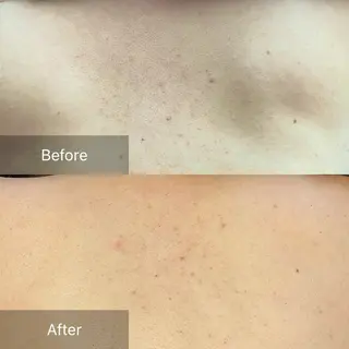 肌育ピーリング 🫧megumiのエステ・リラクイメージ