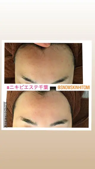 ニキビ/肌質改善専門 Snow skinのエステ・リラクイメージ