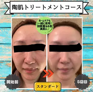 3/25迄ハーブ ピーリングBloomのエステ・リラクイメージ