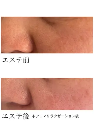 YUI🤍肌悩みに ＊速攻透明感！のエステ・リラクイメージ