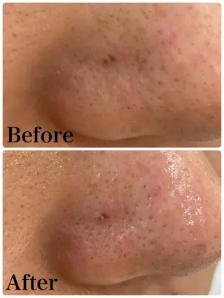 NARIS BEAUTY STATION　デ・アイム 京橋所属・ニキビ跡/毛穴/ 肌質改善/北村ももこのエステ・リラクイメージ