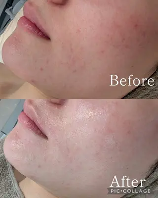 毛穴フェイシャルエステkokotto板橋所属・【毛穴ハーブピーリン グ】板橋1位のエステ・リラクイメージ