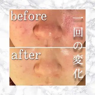 セミロング カラー パーマ ヘアアレンジ メンズ キッズ ネイル マツエク・マツパ アイブロウ ニキビ特化型エステ 🍓最短で肌質改善のエステ・リラクイメージ