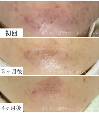 毛穴ケア専門サロンアンスリウム所属・茨城土浦 つくば毛穴 ケア専門サロンのエステ・リラクイメージ