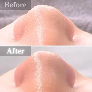 毛穴洗浄特化🫧 オオツカのエステ・リラクイメージ