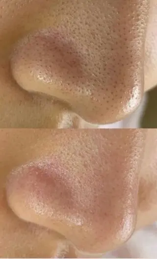 毛穴/毛穴洗浄専門 エミルカ船橋のエステ・リラクイメージ