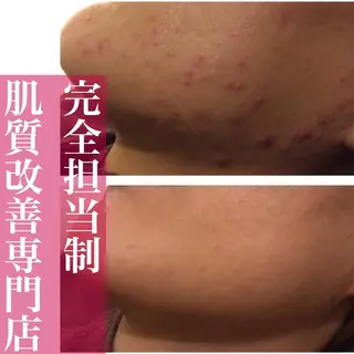 都内で出来る肌管理！ 最短ニキビ改善のエステ・リラクイメージ