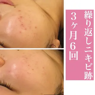 学生ニキビ改善🍀 優しい肌質改善のエステ・リラクイメージ