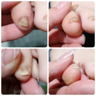 ネイル 深爪・巻き爪 専門サンセリテのネイルデザイン