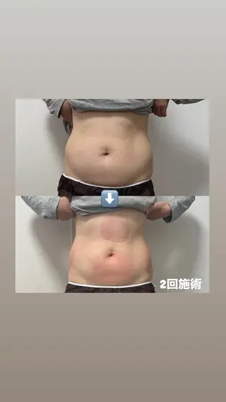 Miiju.所属・Miiju. 石巻市 脂肪冷却  鈴木のエステ・リラクイメージ