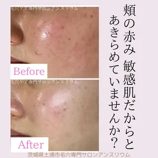 毛穴ケア専門サロンアンスリウム所属・茨城土浦 つくば毛穴 ケア専門サロンのエステ・リラクイメージ