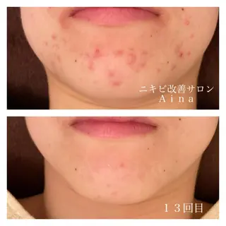 セミロング カラー パーマ ヘアアレンジ メンズ キッズ ネイル マツエク・マツパ ニキビ跡専門サロン Ainaのエステ・リラクイメージ