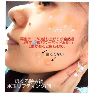 【ニキビ/肌管理】 salon varyのエステ・リラクイメージ