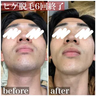 メンズ HAIRS YOSHIOKA所属・ヘアーズヨシオカ MENSヒゲ脱毛のエステ・リラクイメージ