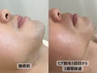 メンズ みんなの LED脱毛のエステ・リラクイメージ