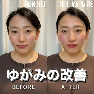 メンズ 即小顔♥️美容鍼× ハーブピーリングのその他イメージ