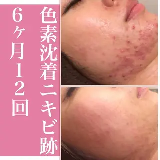 セミロング カラー パーマ ヘアアレンジ メンズ ネイル マツエク・マツパ 都内で出来る肌管理！ 最短ニキビ改善のエステ・リラクイメージ