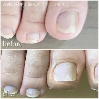 ネイル 深爪・巻き爪 専門サンセリテのネイルデザイン