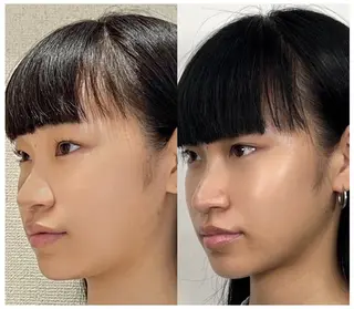 ✨隆鼻矯正✨ 田村のエステ・リラクイメージ