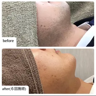 メンズ ☀️Akala☀️ メンズ脱毛のエステ・リラクイメージ