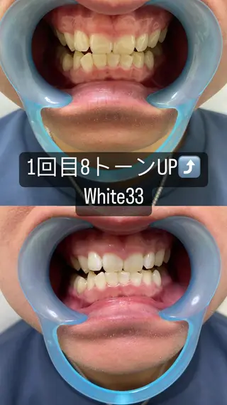 メンズ セルフホワイトニング White33大名のその他イメージ