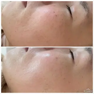 ネイル マツエク・マツパ ニキビ・毛穴改善 🌿ハーブピーリングのエステ・リラクイメージ