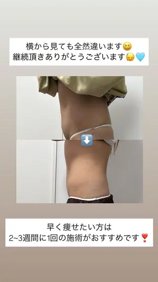 Miiju.所属・Miiju. 石巻市 脂肪冷却  鈴木のエステ・リラクイメージ