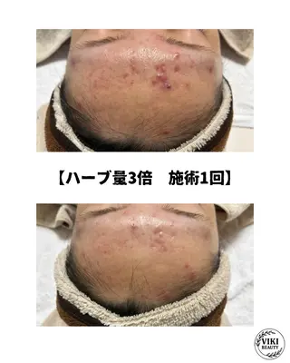 VIKI BEAUTY  クレイハーブピーリング・美肌脱毛専門店所属・VIKI BEAUTYのエステ・リラクイメージ