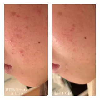 セミロング カラー パーマ ヘアアレンジ メンズ キッズ ネイル マツエク・マツパ ニキビ跡専門サロン Ainaのエステ・リラクイメージ