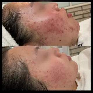 サロンドエクラ南堀江所属・ニキビ・毛穴専門 肌質改善サロンのエステ・リラクイメージ