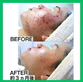 ニキビケア◇ニキビ跡 レゾン京橋店　峠山のエステ・リラクイメージ