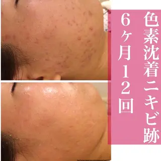 夏までに肌荒れ卒業 するサロン🌻のエステ・リラクイメージ