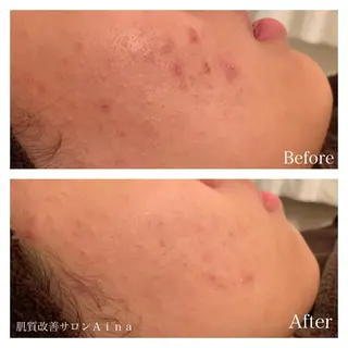 ミディアム パーマ キッズ ネイル マツエク・マツパ ニキビ跡専門サロン Ａｉｎａのエステ・リラクイメージ