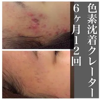 セミロング カラー パーマ ヘアアレンジ メンズ キッズ ネイル マツエク・マツパ アイブロウ 夏までに肌荒れ卒業 するサロン🌻のエステ・リラクイメージ