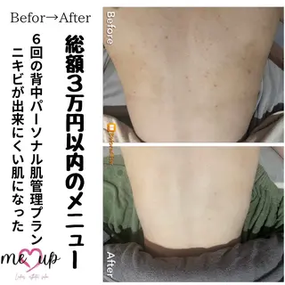 Meupニキビ専門店 背中/ハーブ/肌管理のその他イメージ