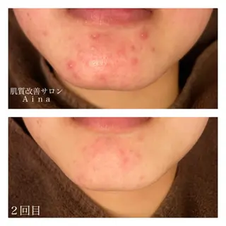 ショート カラー パーマ ヘアアレンジ メンズ キッズ ネイル マツエク・マツパ ニキビ跡専門サロン Ａｉｎａのエステ・リラクイメージ