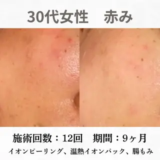 重度ニキビ専門🌷 ダウンタイムなしのエステ・リラクイメージ