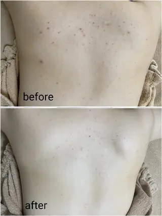 ニキビケア＆ニキビ跡 レゾン京橋店　のエステ・リラクイメージ