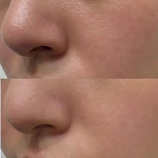 ニキビ跡改善専門🔥 医療にはできない改善のエステ・リラクイメージ